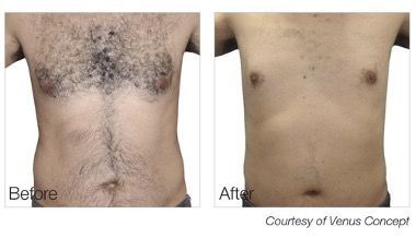 A before and after picture of a man 's chest hair removal.