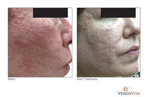 A before and after photo of a woman 's face