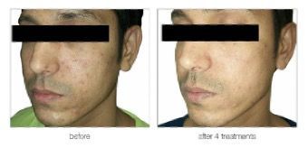 A before and after picture of a man 's face