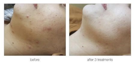 A before and after picture of a person 's face