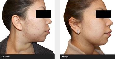 A before and after photo of a woman 's face