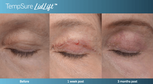 A before and after photo of a woman 's eye