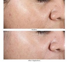 A before and after photo of a woman 's face.