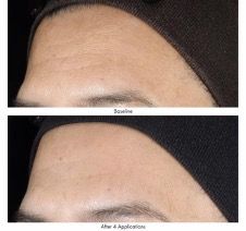 A before and after photo of a woman 's forehead.