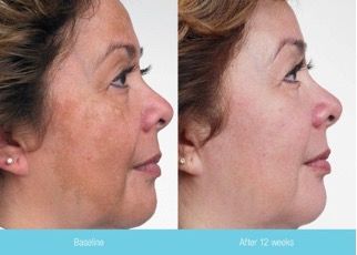 A before and after photo of a woman 's face.