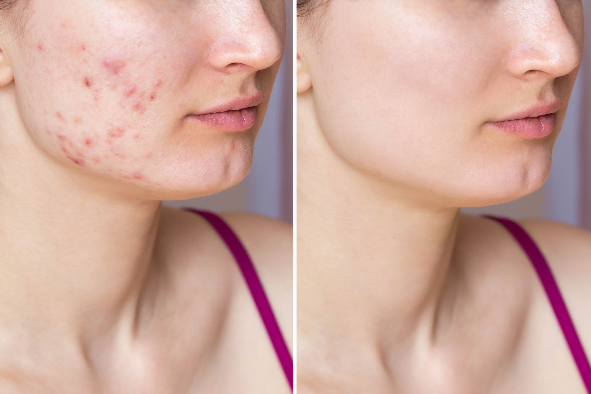 Side-by-side comparison of a person's cheek showing a reduction in acne and skin inflammation after treatment.
