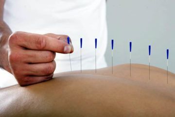 Acupuncturist inserting needles into a person's back; needles are blue and silver.