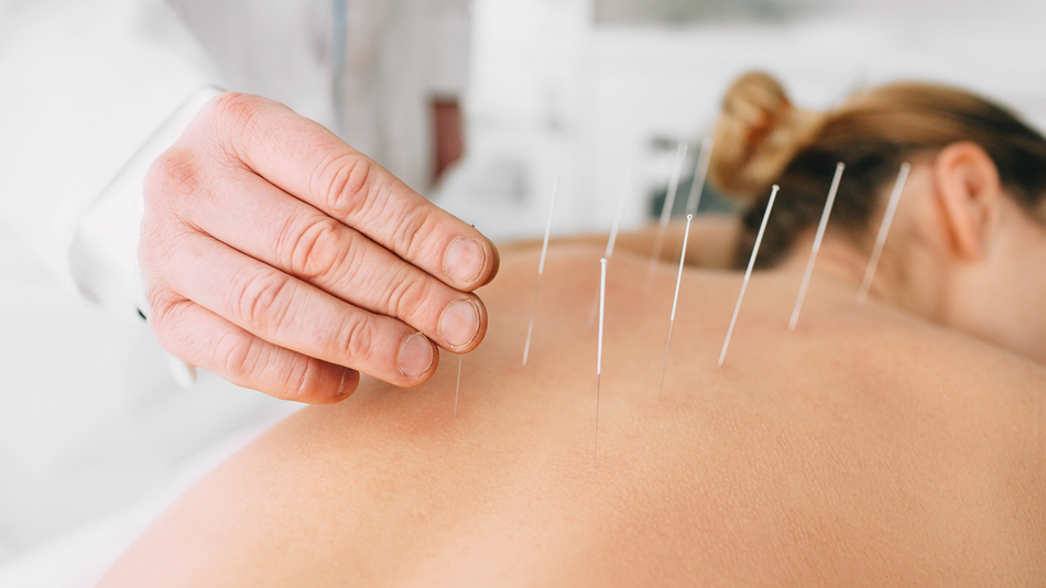 Person receiving acupuncture treatment on their back, needles inserted, light setting.