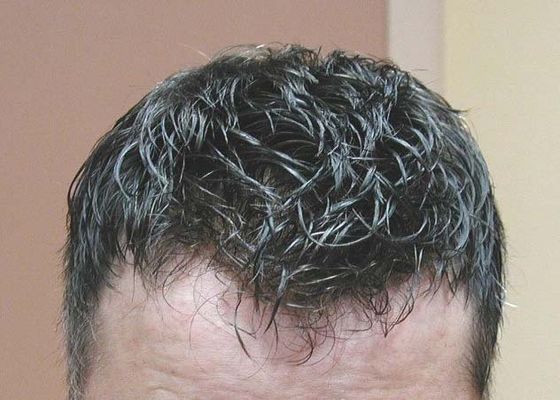 Focus On Hair Of A Man — New York, NY — Manny Roberts Hair Replacement