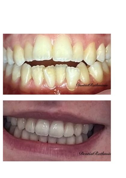 Patient open bite before Invisalign treatment at Dentist Rathmines
