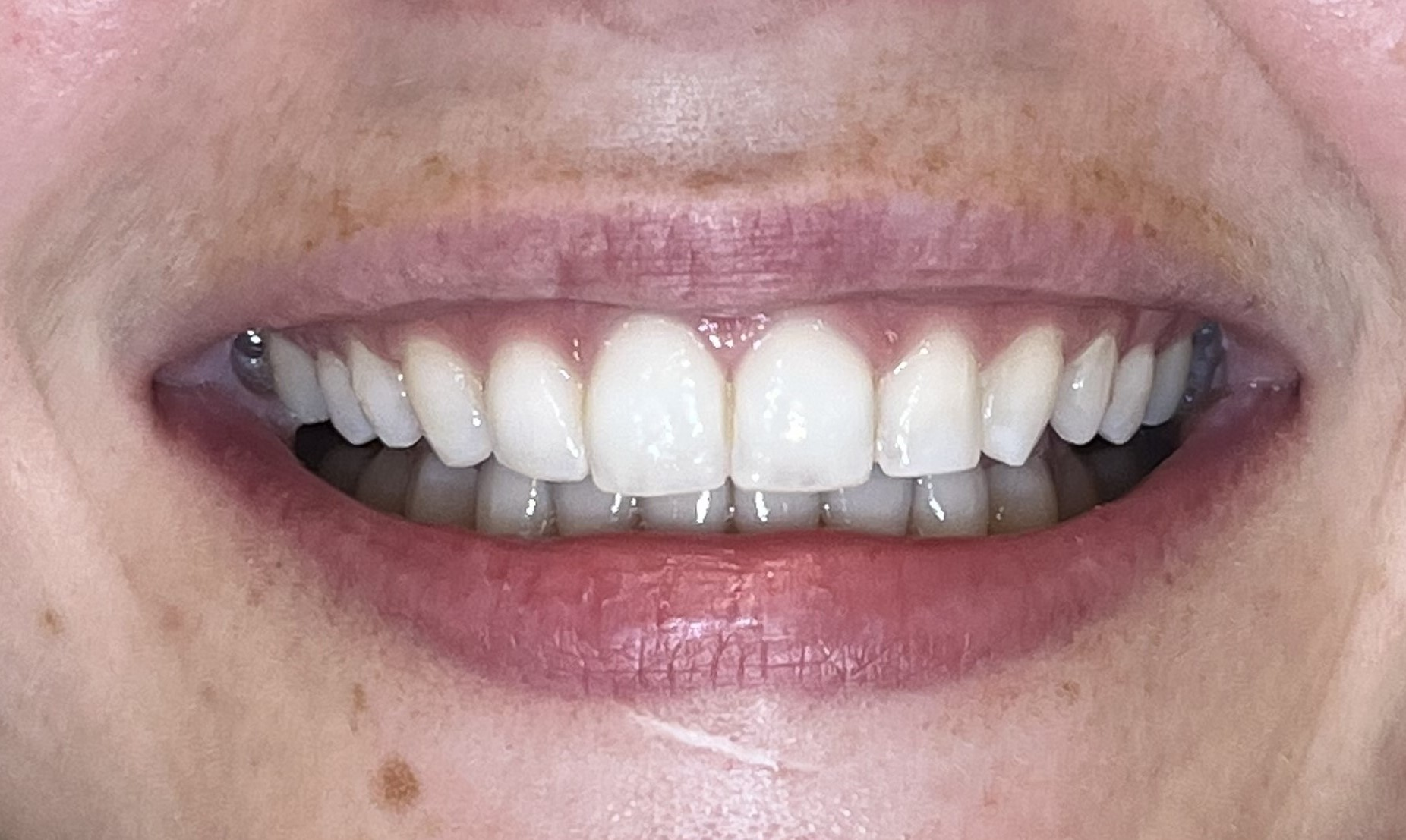Close-up of straight, aligned smile after Invisalign treatment at Dentist Rathmines Dublin