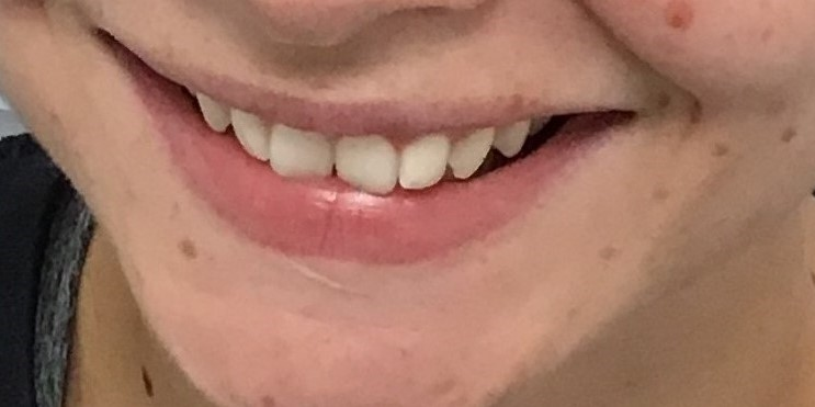 Close-up of crooked teeth before Invisalign treatment at Dentist Rathmines Dublin