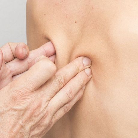 Hands pinching skin on a person’s back, showing a skin fold test
