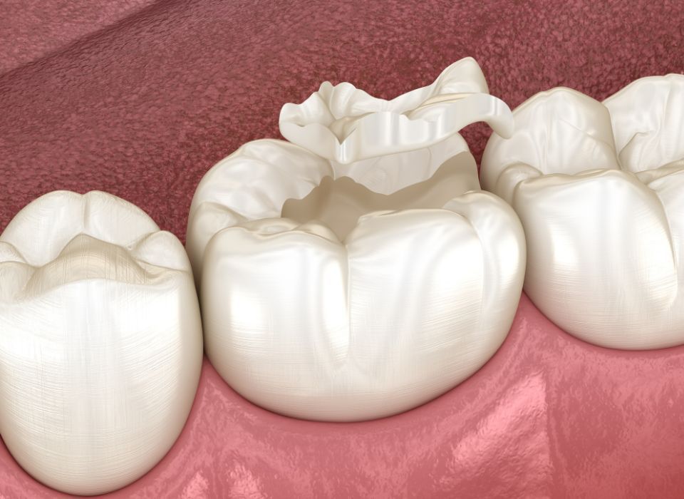Close-up of teeth with a tooth filling that is damaged and torn. Red gums are visible.