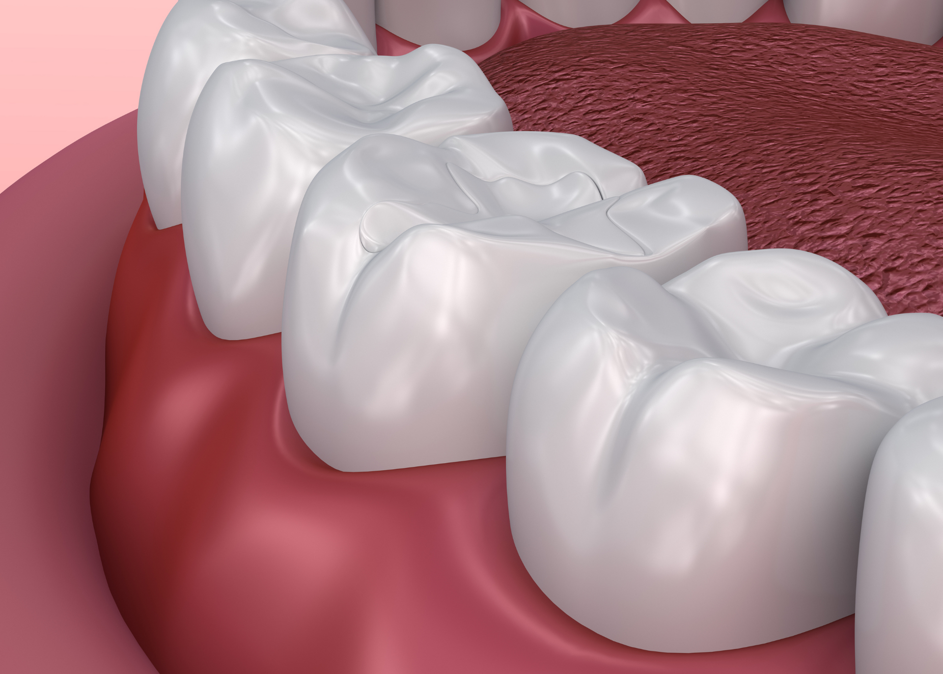 Close-up of upper teeth, showing healthy gums and a slight crack in one molar.