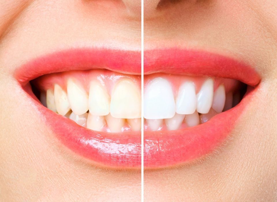 Woman's smile showing before and after teeth whitening comparison. One side is yellow, the other white.