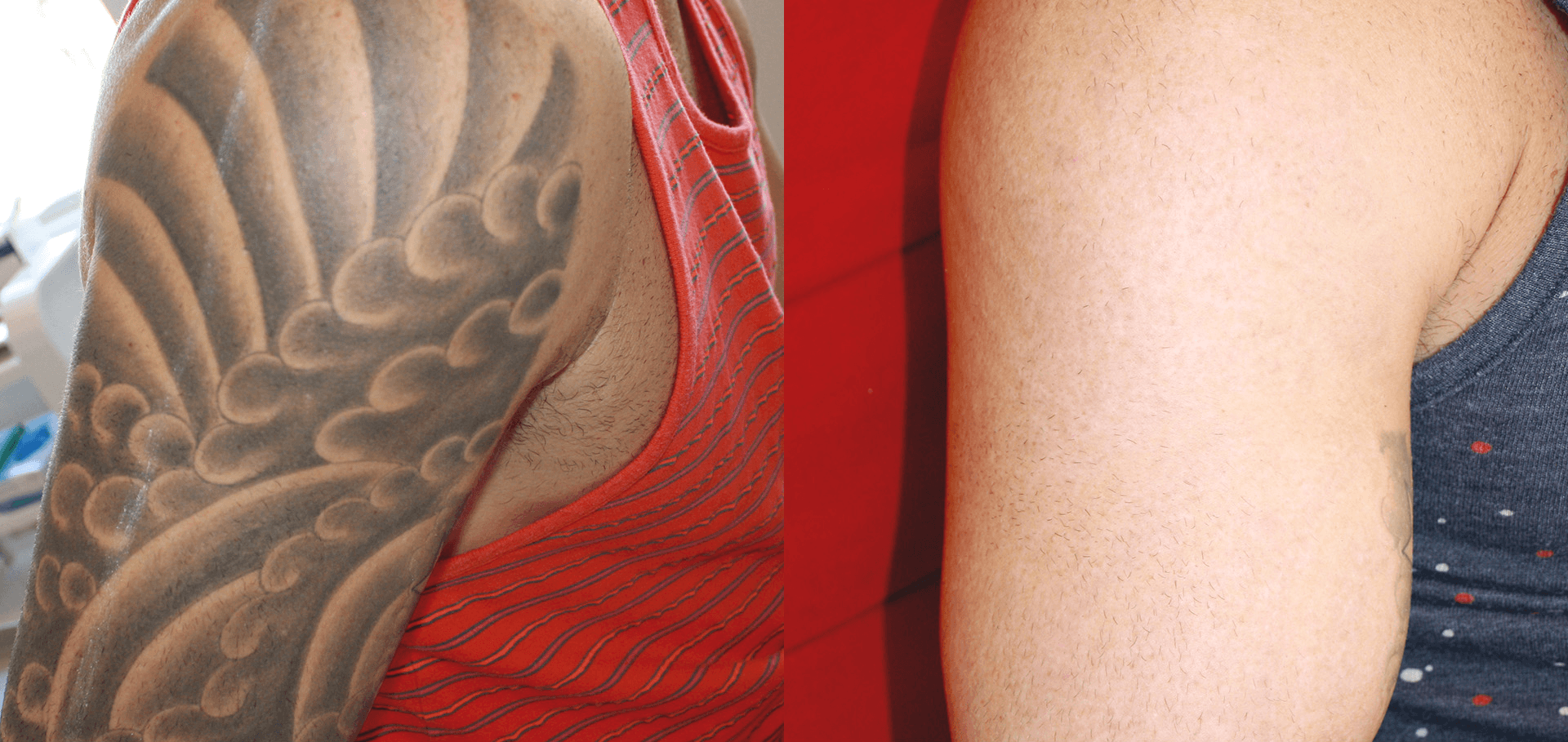 Remarkable tattoo removal results from Premier Beauty Medical Aesthetics in Redlands. Before: large detailed shoulder tattoo. After: completely clear skin with no visible ink. Advanced PicoSure laser technology delivering superior results for tattoo removal in the Inland Empire.