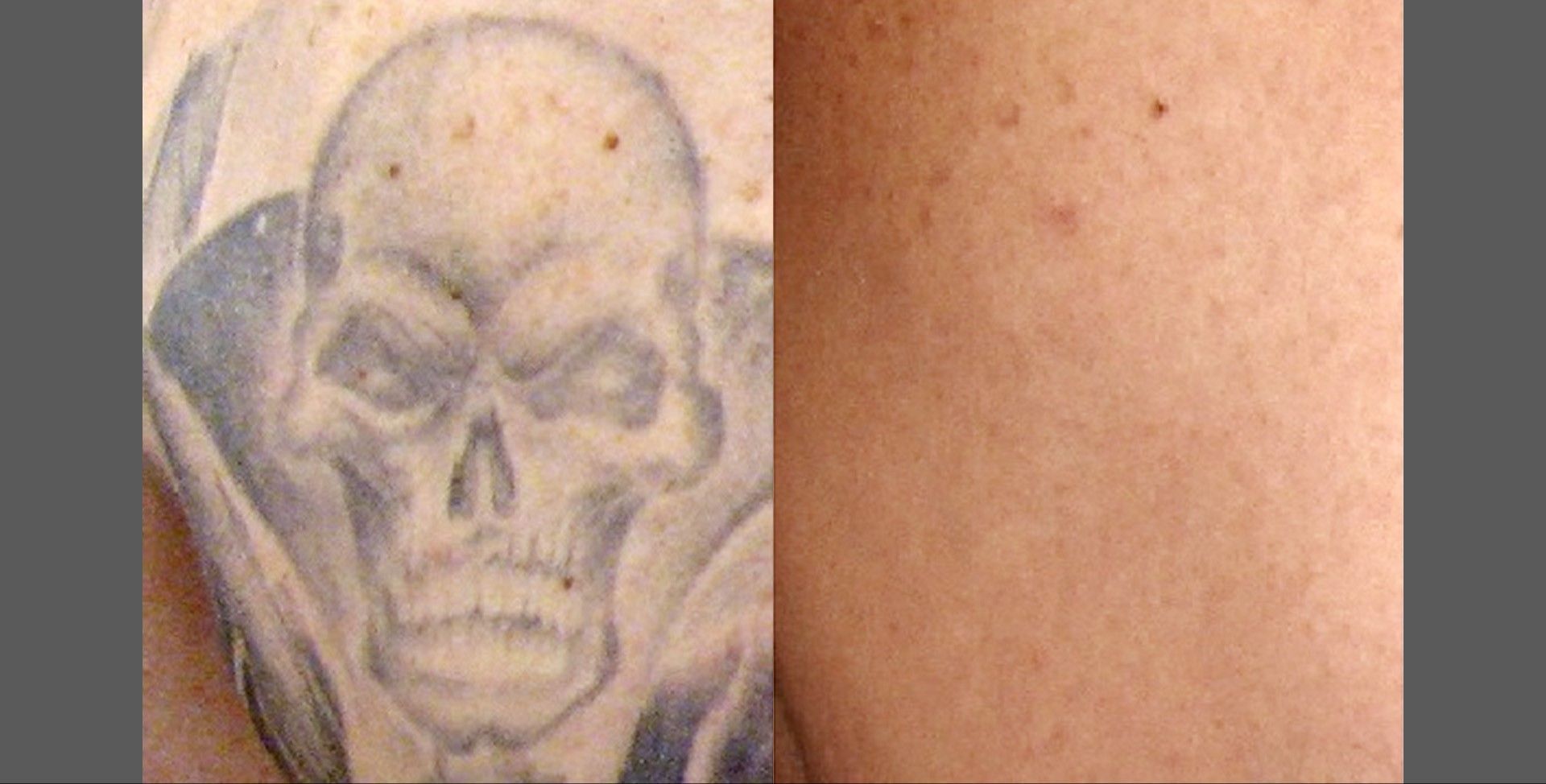 100% tattoo removal results at Premier Beauty Medical Aesthetics Redlands. Before: dark skull tattoo. After: completely clear skin with no visible ink. Leading tattoo removal specialists serving San Bernardino County and the Inland Empire
