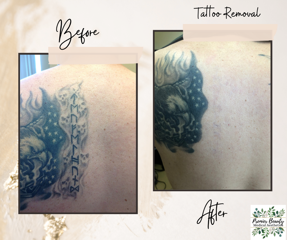 Effective tattoo removal before and after results from Premier Beauty Medical Aesthetics in Redlands. Professional laser tattoo removal service in the Inland Empire successfully removing dark ink American flag and text tattoo with minimal sessions.