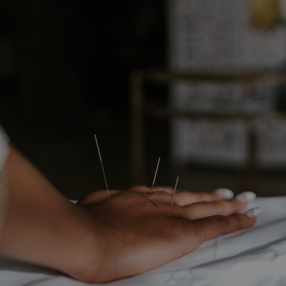 acupuncture