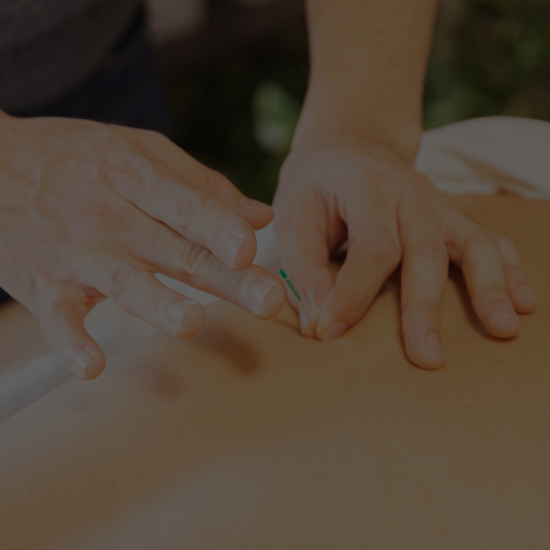 Acupuncture’s 