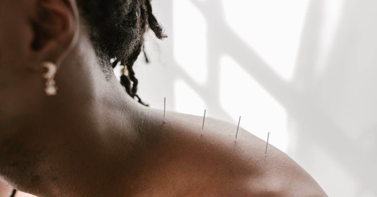 Acupuncturist