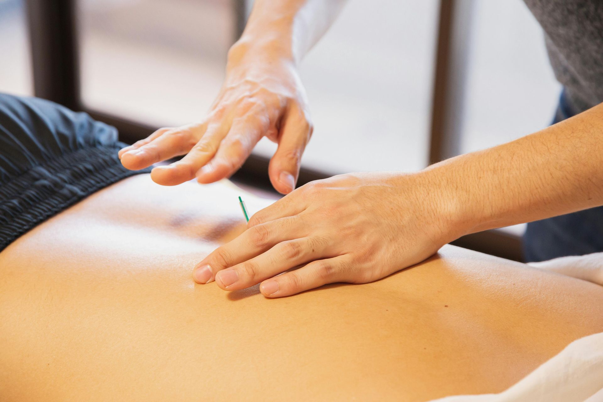 Patient lying face down with several thin acupuncture needles inserted along the upper back while a practitioner’s hands are positioned nearby.