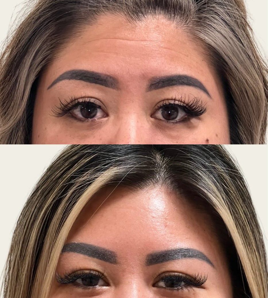 A before and after photo of a woman 's forehead.