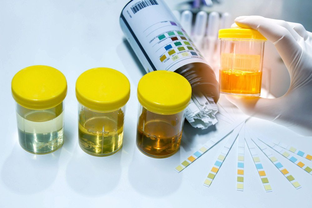 A Person is Holding a Jar of Urine Next to Four Jars of Urine — Mount Archer Medical Centre in Berserker, QLD