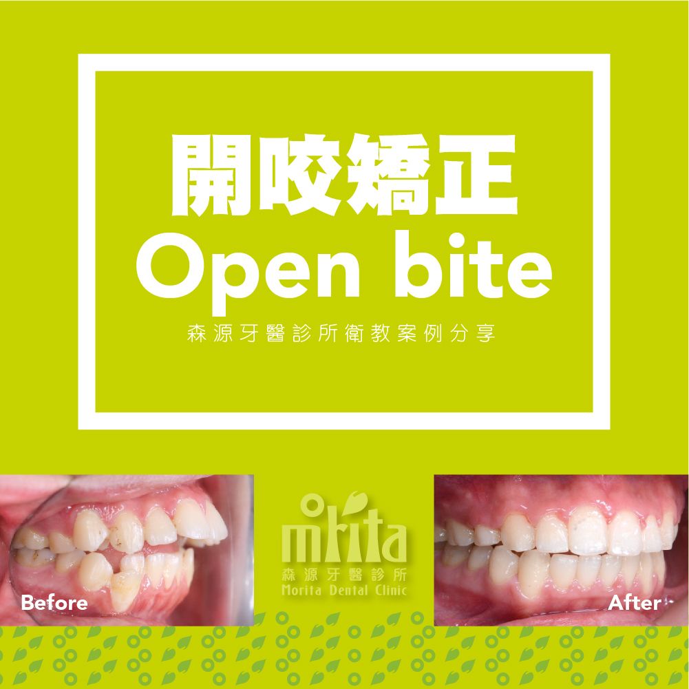 A picture of a person 's teeth before and after braces.