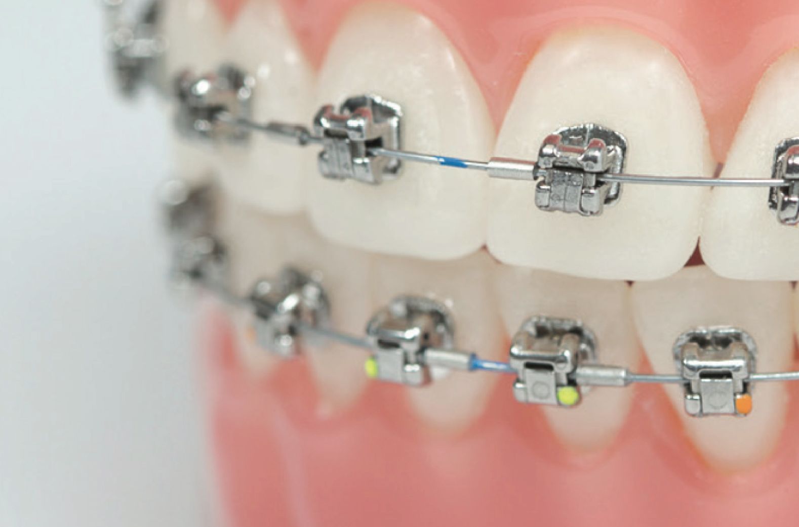 A close up of a model of teeth with braces on them.