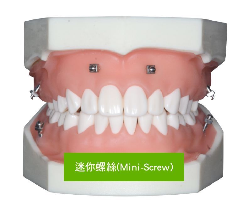 A model of teeth with a green label that says mini-screw