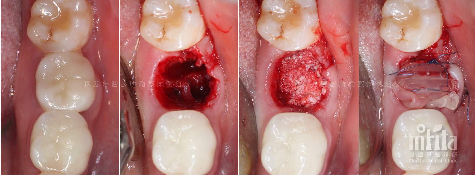 A close up of a person 's teeth before and after a dental procedure.