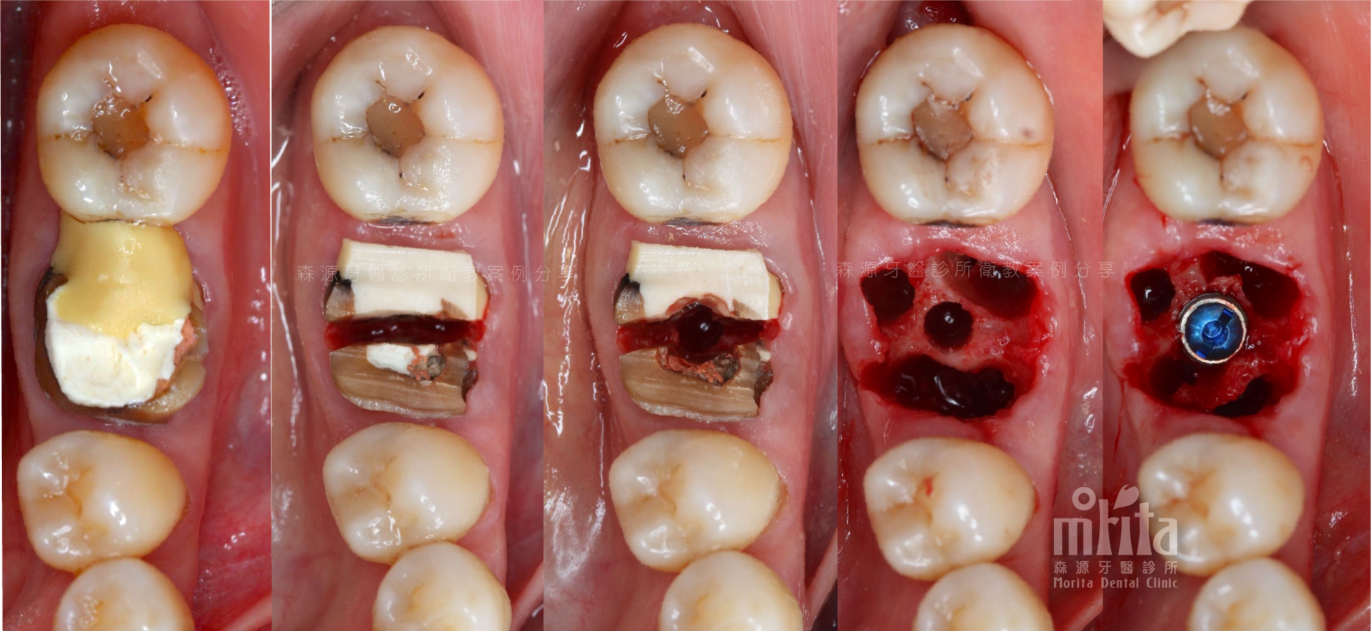 A close up of a person 's teeth showing different stages of dental treatment