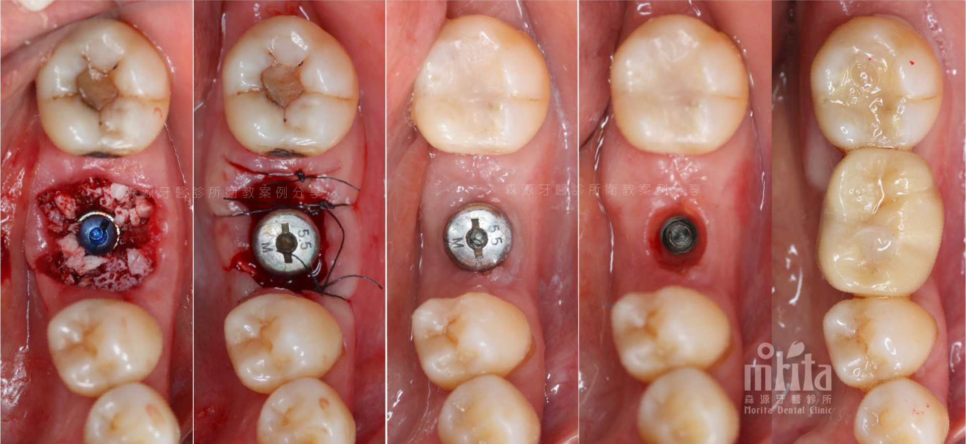 A close up of a person 's teeth with screws in them