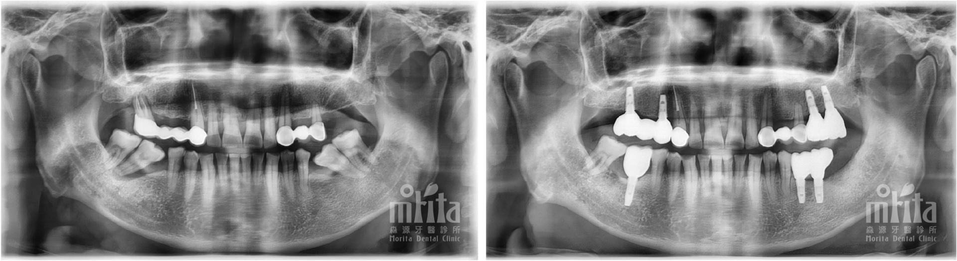 A black and white x-ray of a person 's teeth.