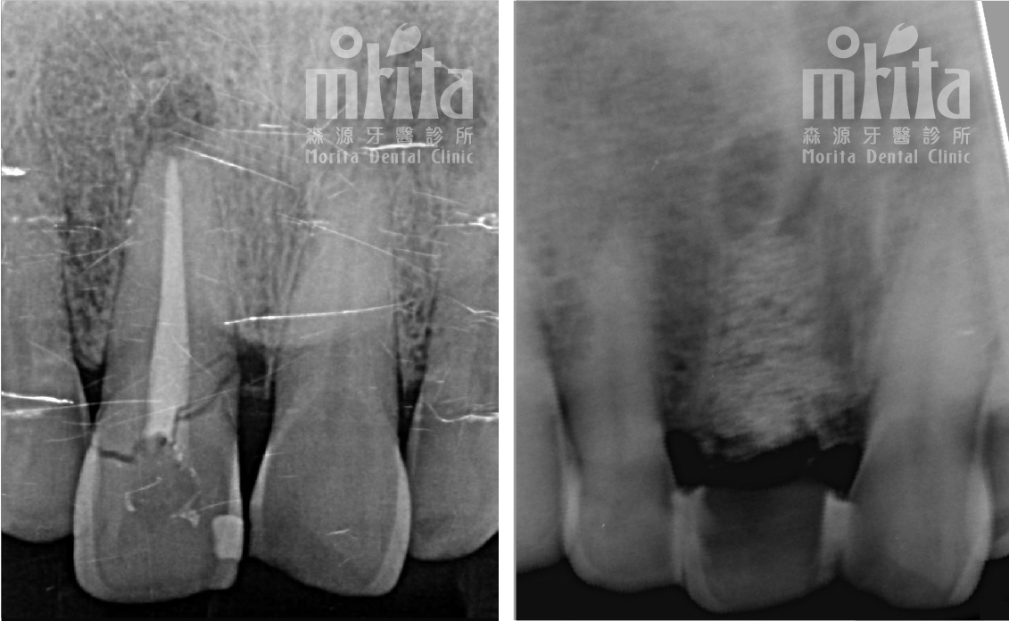 A black and white photo of a person 's teeth before and after treatment.