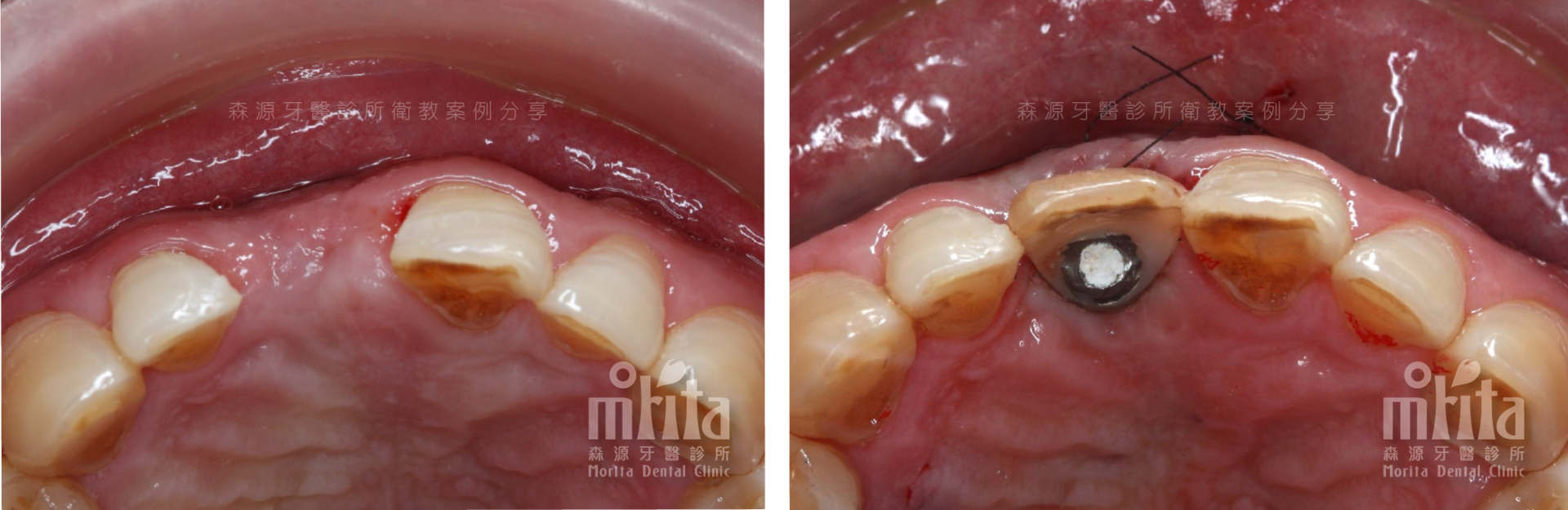 A before and after picture of a person 's mouth with a tooth missing.