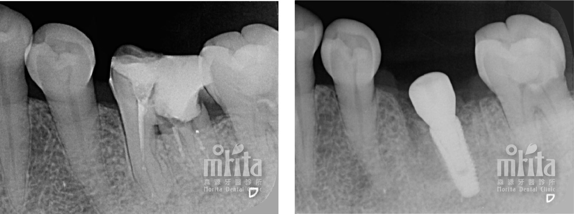 A black and white x-ray of a tooth with a hole in it.