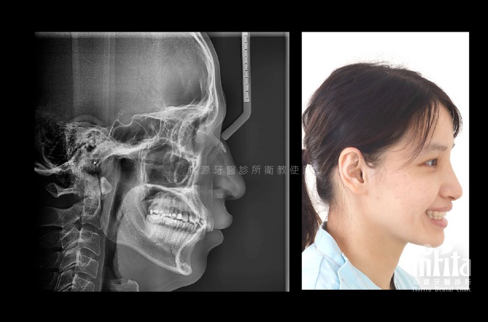 An x-ray of a woman 's skull and a picture of a woman 's face.