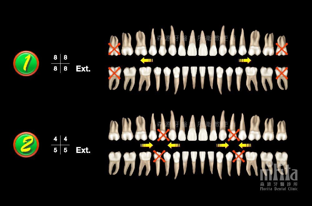 A diagram of a person 's teeth showing the number 1 and 2