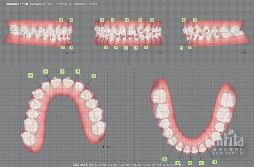 A computer generated image of a person 's teeth with braces.