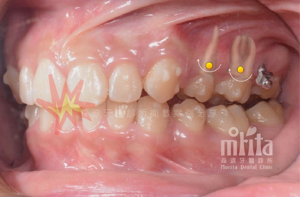 A close up of a person 's teeth with a tooth missing.