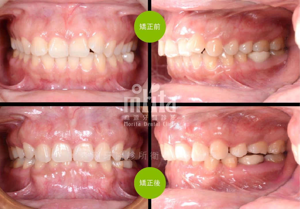 A before and after picture of a person 's teeth