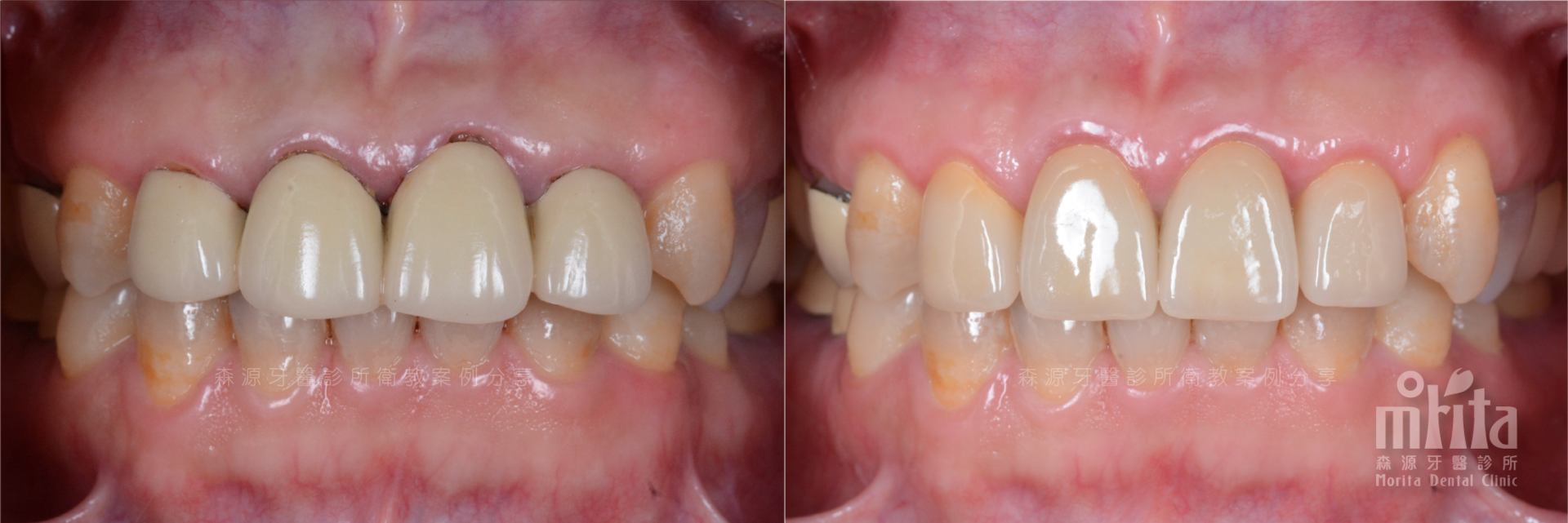 A before and after picture of a person 's teeth