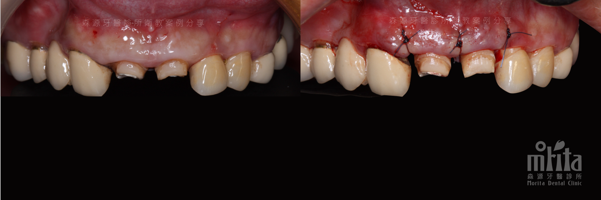 A before and after picture of a person 's teeth