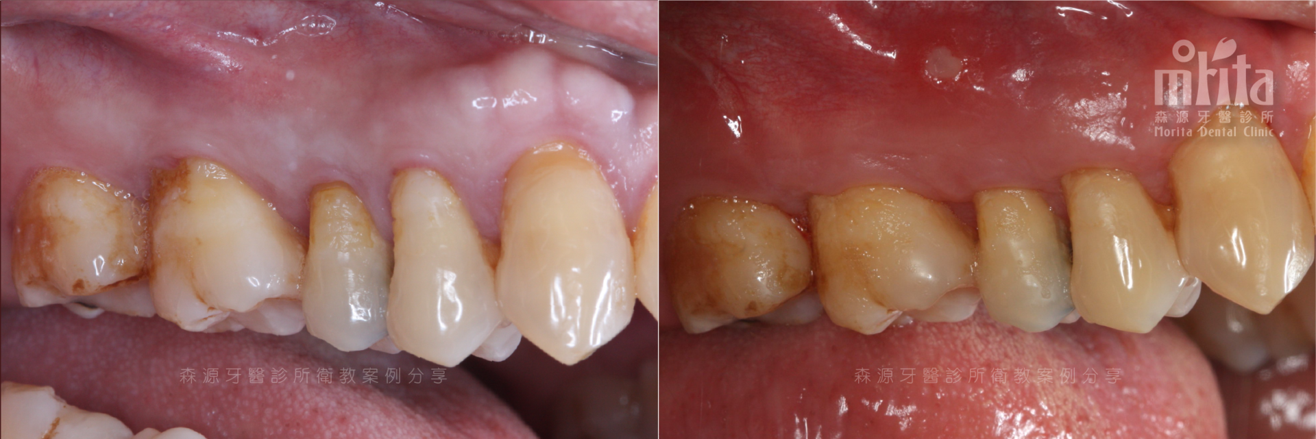 A before and after picture of a person 's teeth.