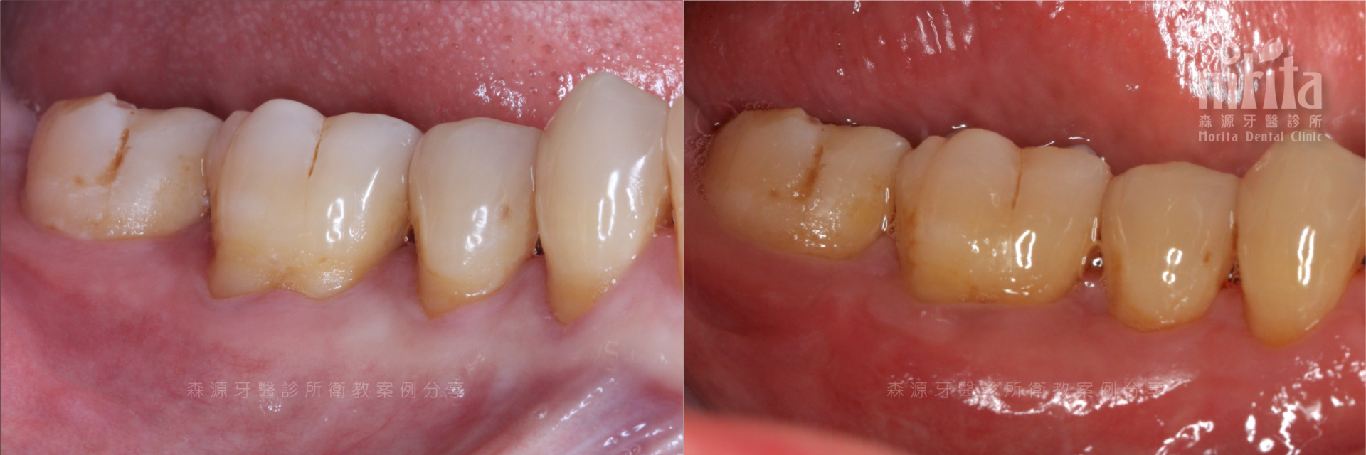A before and after picture of a person 's teeth