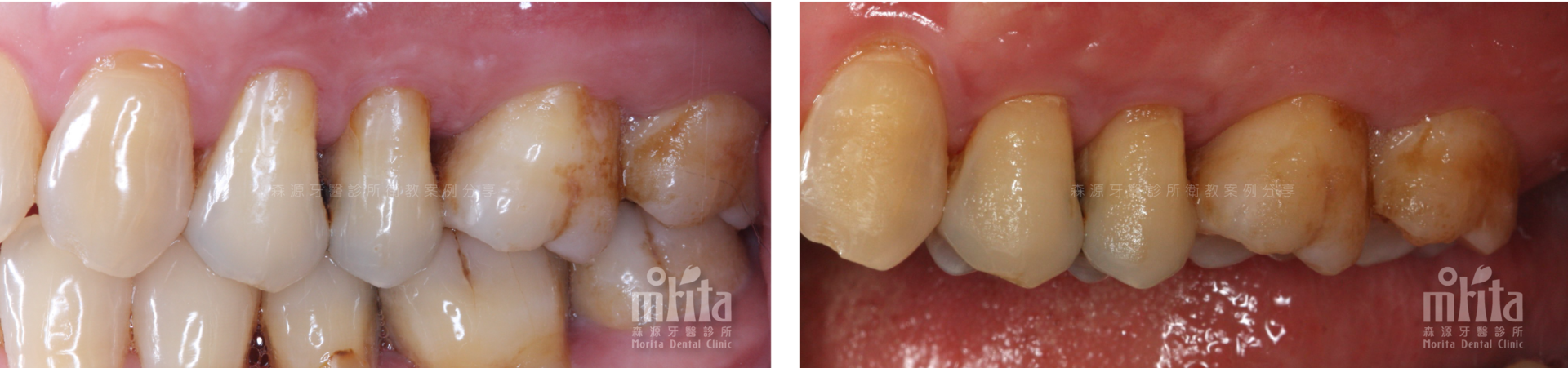 A before and after picture of a person 's teeth.