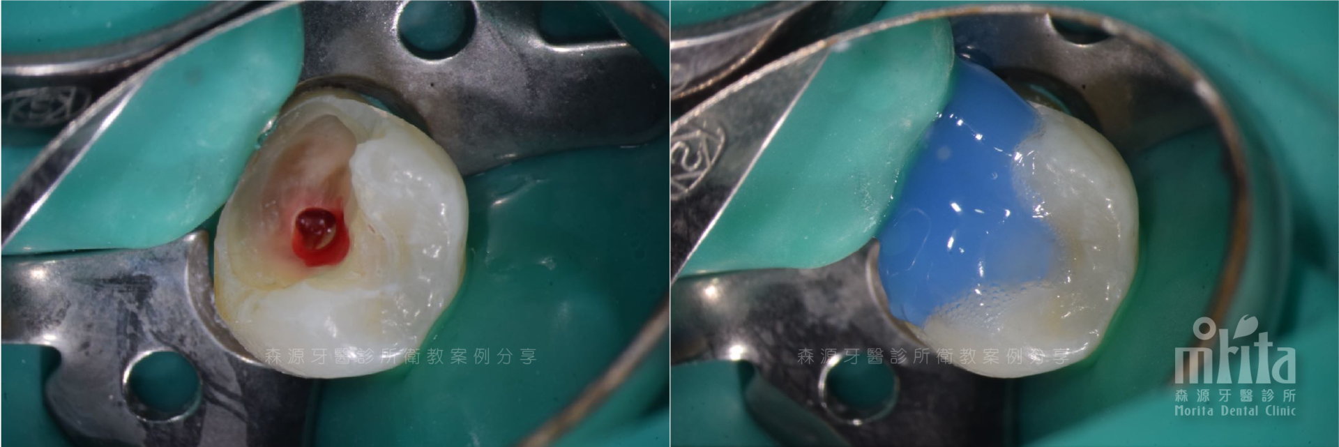 A before and after picture of a tooth with a hole in it.